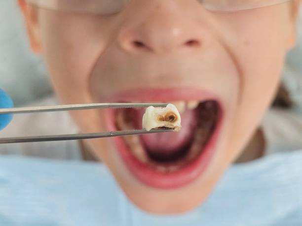 Best Dentist for Tooth Abscess  in Citrus Hills, FL